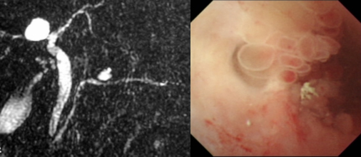 左図：MRCP検査   右図：ERCPによる膵管鏡検査