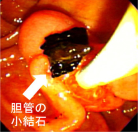 図2：原発性硬化性胆管炎に対する内視鏡治療 胆管内から結石が十二指腸へ排出されました。