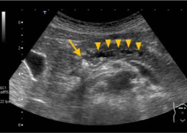 慢性膵炎の超音波画像