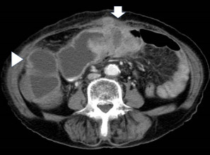図1. 大腸閉塞の腹部CT検査