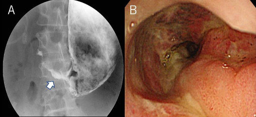 図2. 胃十二指腸閉塞における消化管造影検査、内視鏡検査