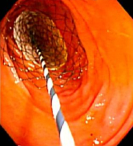 図3. 胃十二指腸閉塞に対するステント留置の内視鏡写真