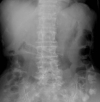 図4. 胃十二指腸閉塞に対するステント留置のレントゲン写真