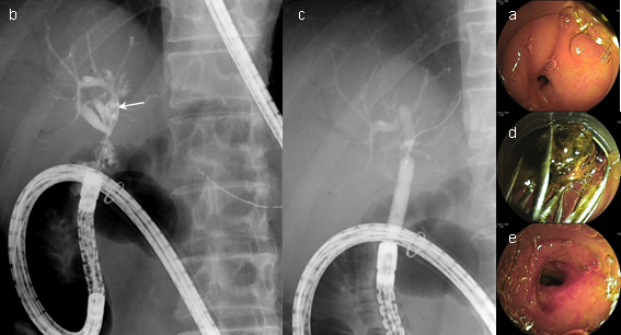 図3（症例1）膵頭十二指腸切除術後、胆管空腸吻合部狭窄、胆管結石