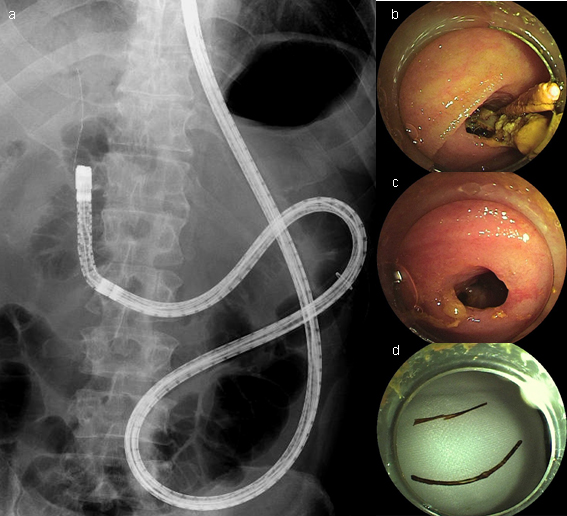 図4（症例2）膵頭十二指腸切除術後、胆管ステント遺残、胆管結石